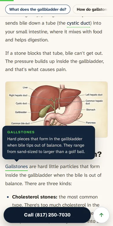 The same page with the glossary definition of gallstones open over the text